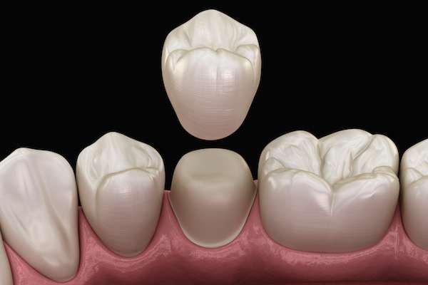 What To Ask Your General Dentist When Preparing for a Crown from Vegas Smiles in Las Vegas, NV
