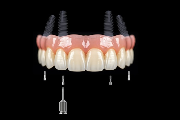 Healing Tips For Implant Supported Dentures